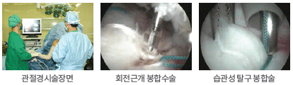관절경 시술장면, 회전근개 봉합수술, 습관성 탈구 봉합술